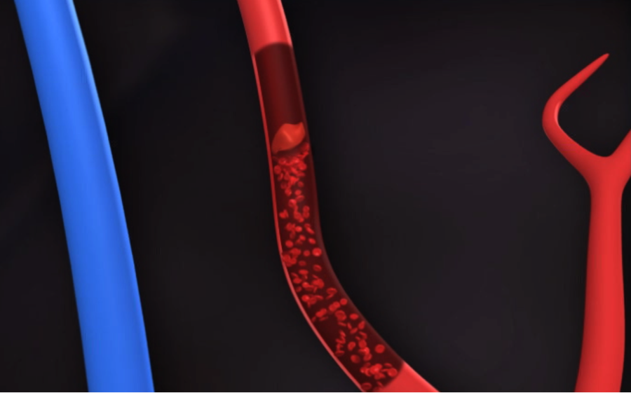 ischemic-4433891